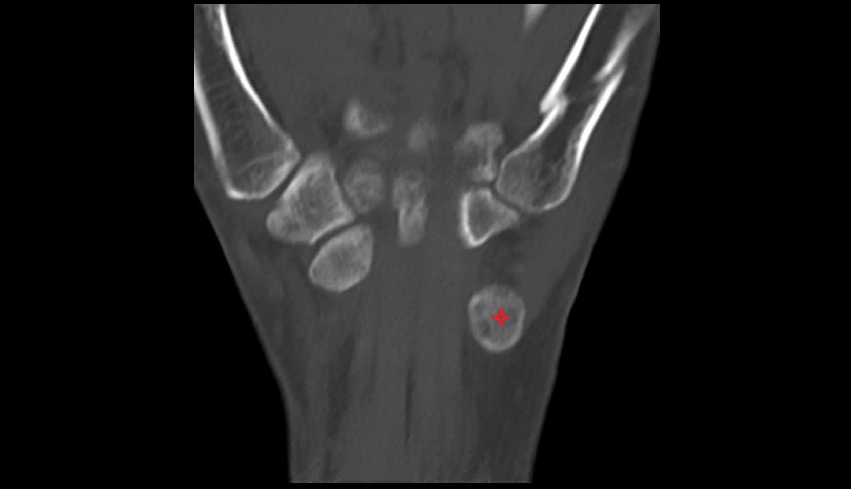 Pisiform ct coronal image
