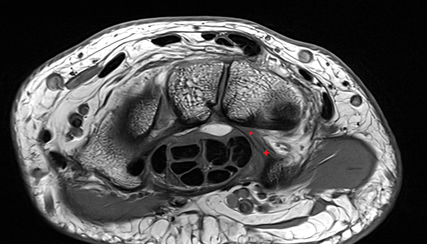 Pisohamate ligament  axial cross sectional anatomy 3T MRI AI enhanced radiology image-img-00000-00000