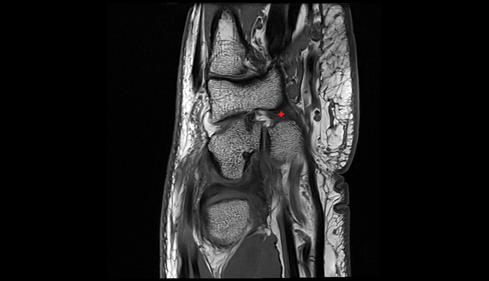 Pisohamate ligament mri sag image