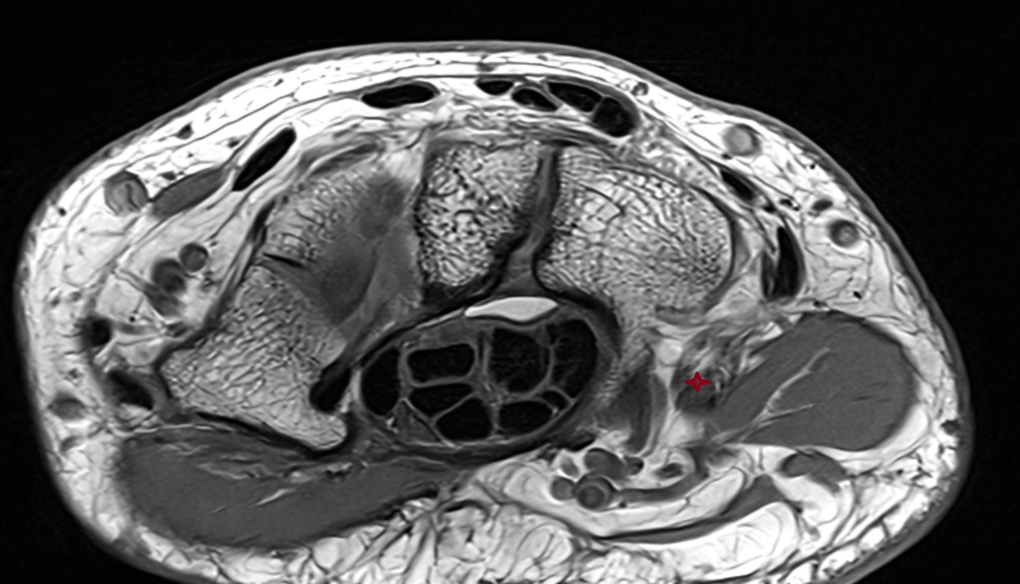 Pisometacarpal ligament  image  axial cross sectional anatomy 3T MRI AI enhanced radiology image-img-00000-00000