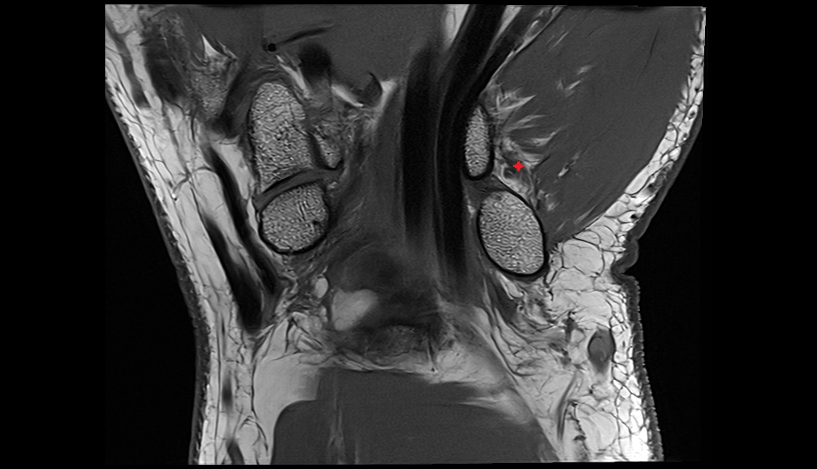 Pisometacarpal ligament mri coronal image 1