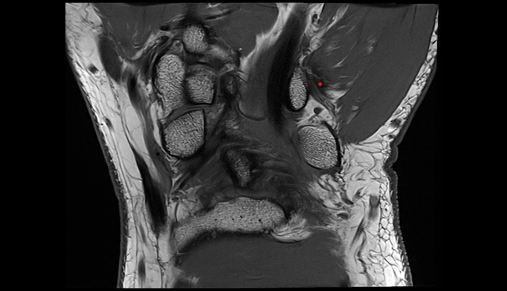 Pisometacarpal ligament mri coronal image 2