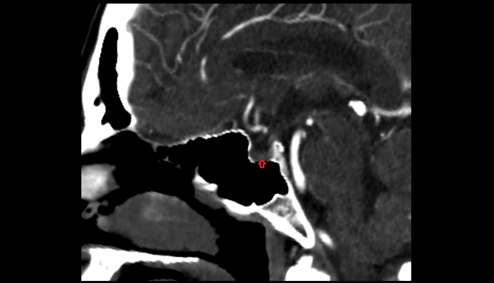 Pituitary gland CT sag image