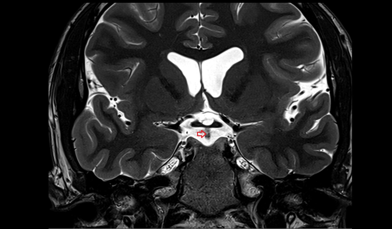Pituitary stalk mri 3t coronal image