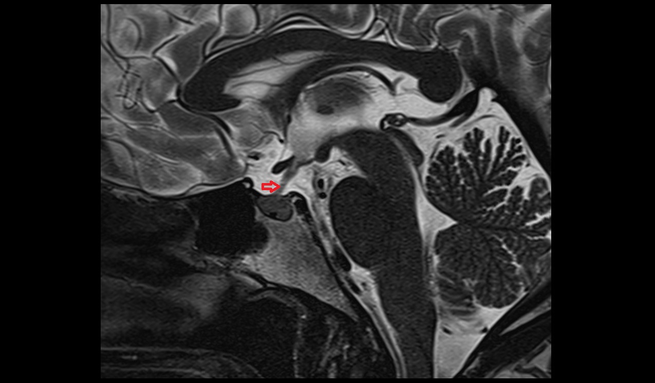 Pituitary stalk mri 3t sagittall image