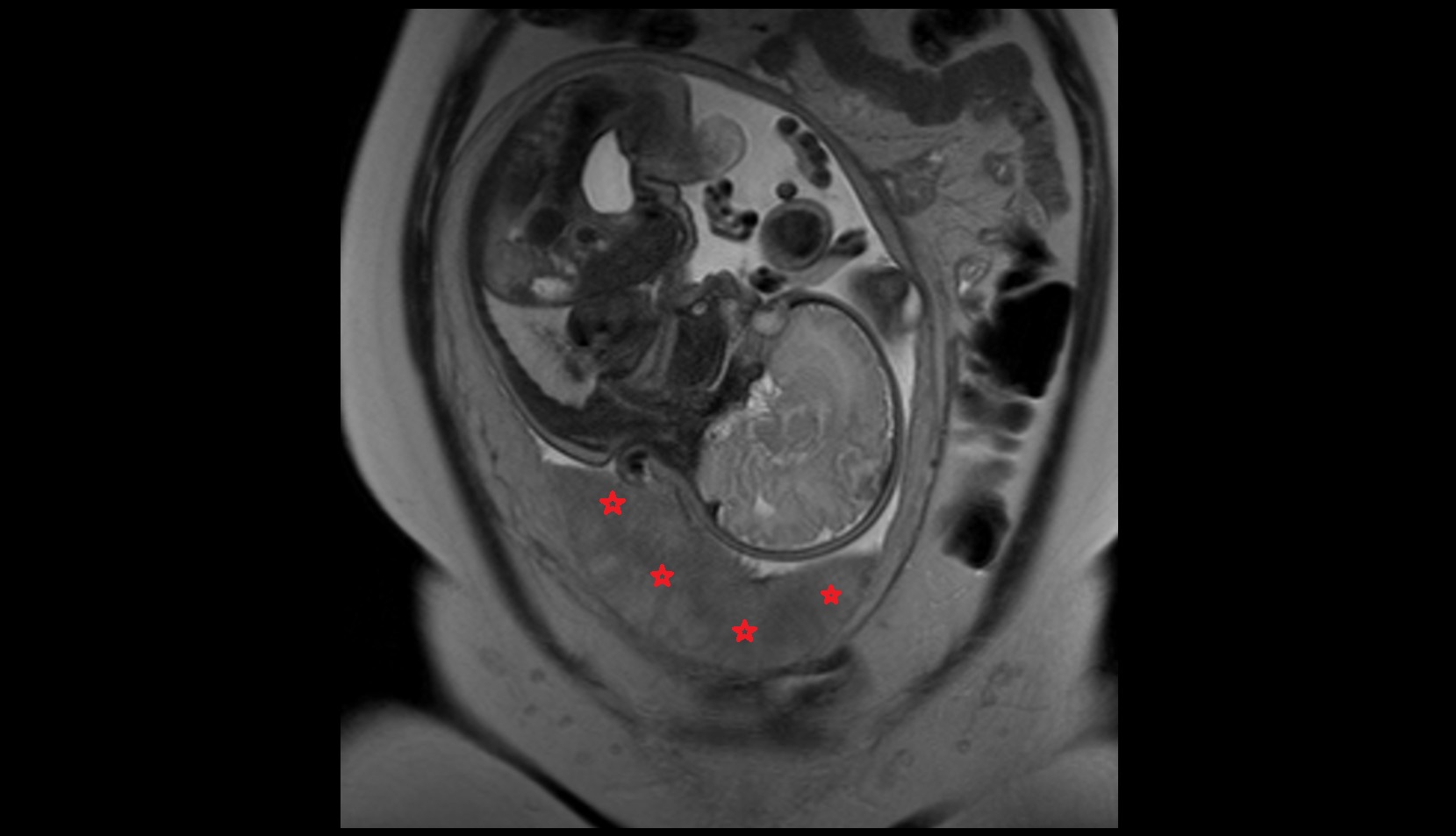 Placenta MRI CORONAL MRI IMAGE