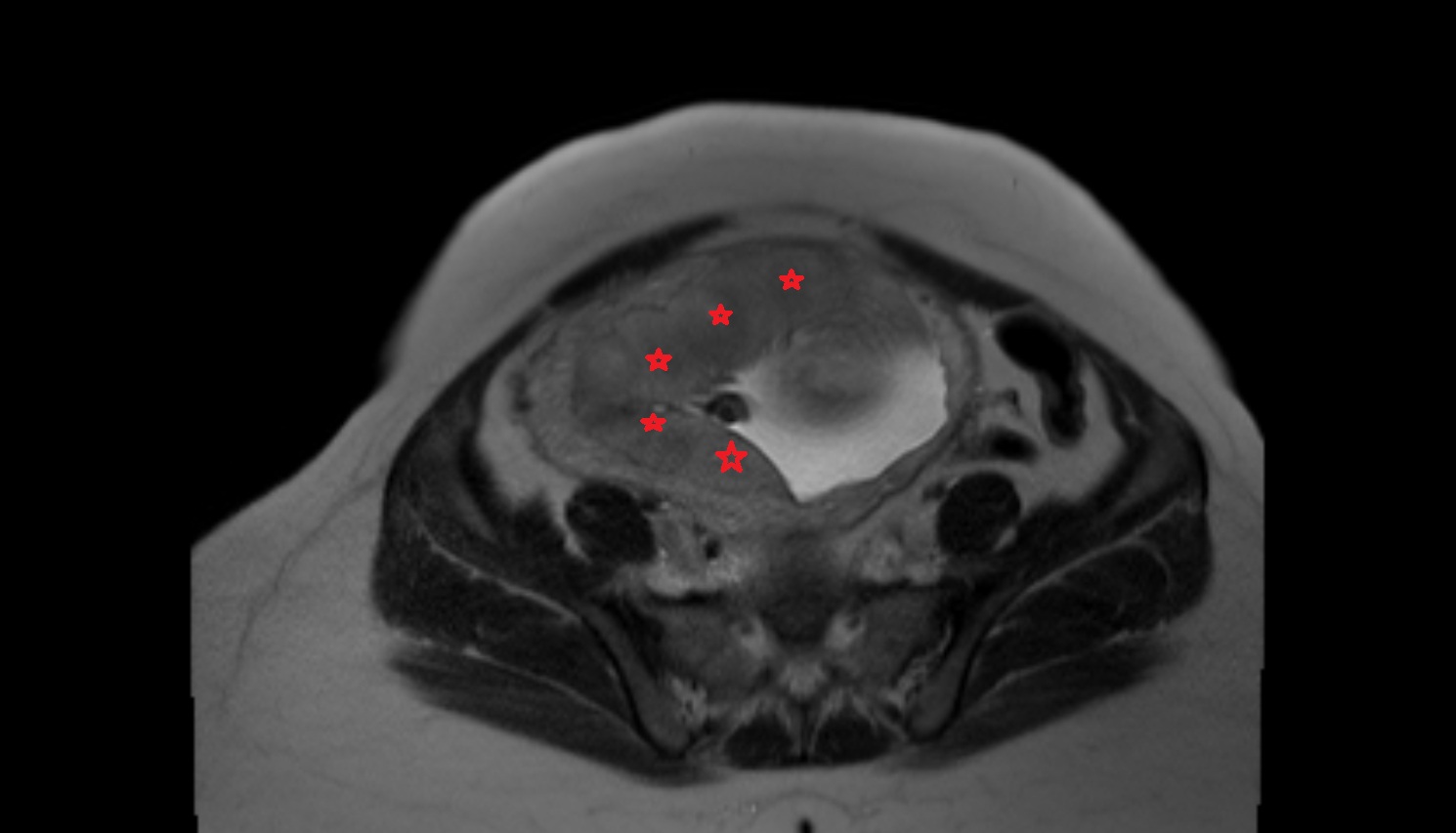Placenta  MRI axial  anatomy image-img-00000-00000