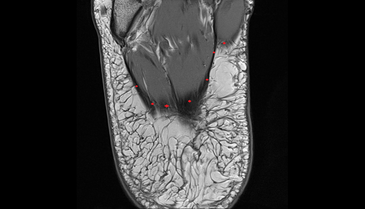 Plantar Aponeurosis  AXIAL  cross sectional anatomy 3T MRI AI enhanced radiology image-img-00000-00000