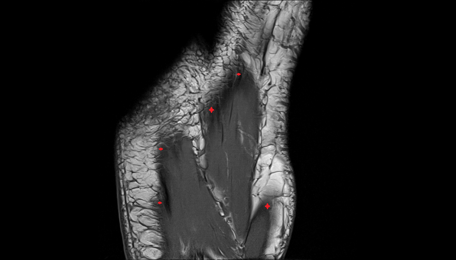 Plantar Aponeurosis  AXIAL  cross sectional anatomy 3T MRI AI enhanced radiology image-img-00000-00000_00001