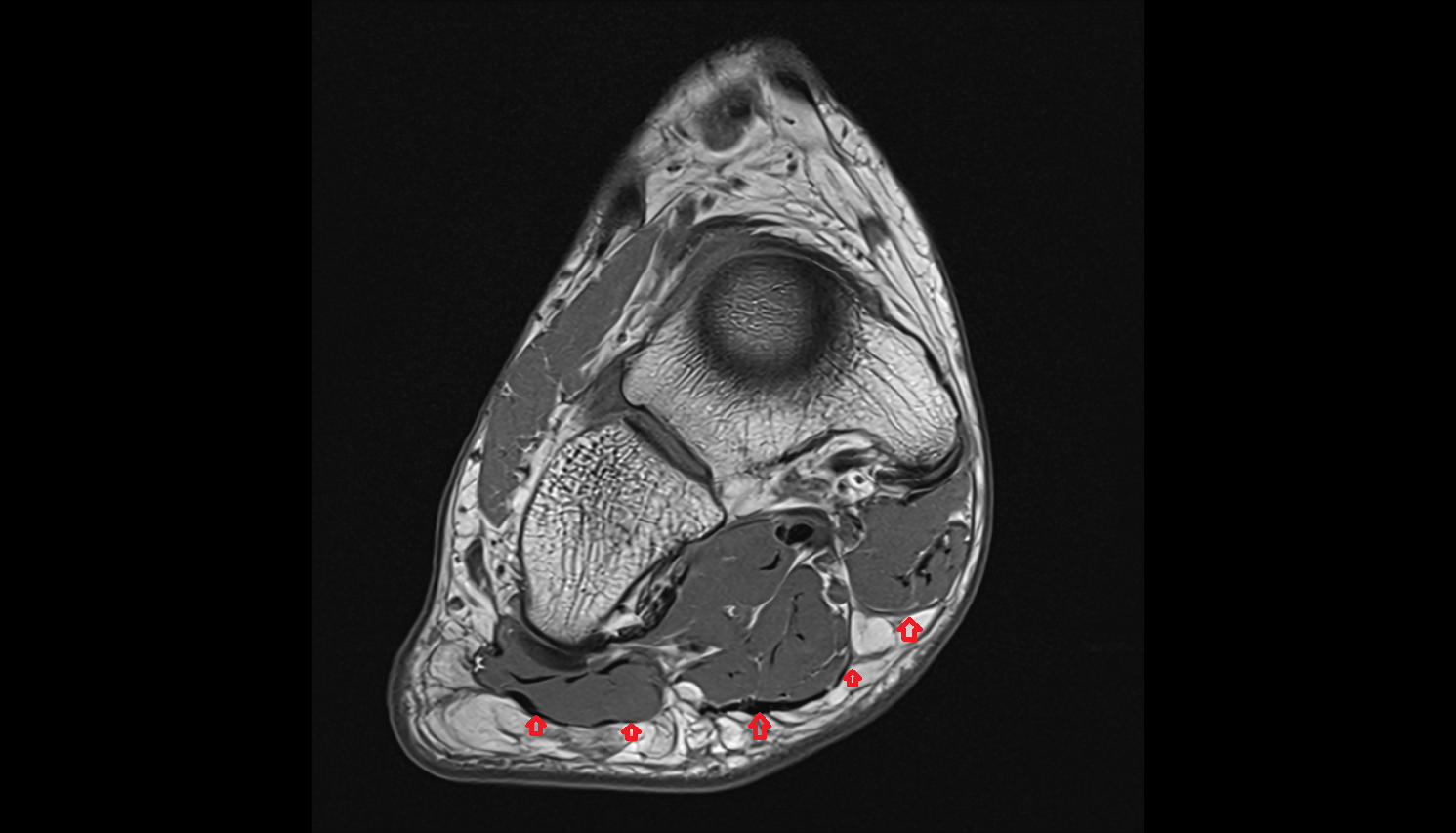 Plantar Aponeurosis  AXIAL  cross sectional anatomy 3T MRI AI enhanced radiology image-img-00000-00000_00002