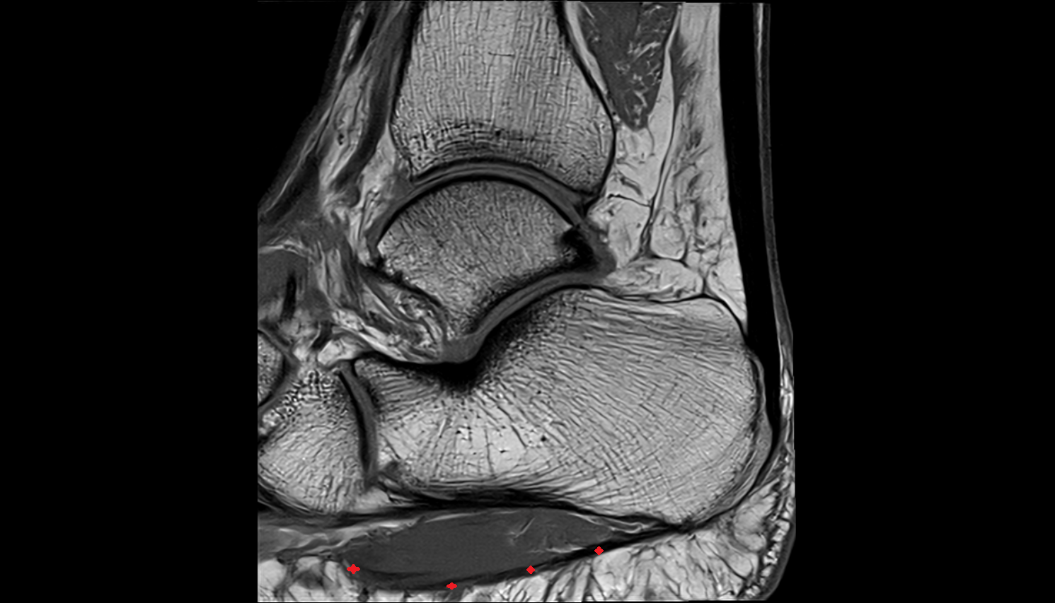 Plantar Aponeurosis  sag  cross sectional anatomy 3T MRI AI enhanced radiology image-img-00000-00000