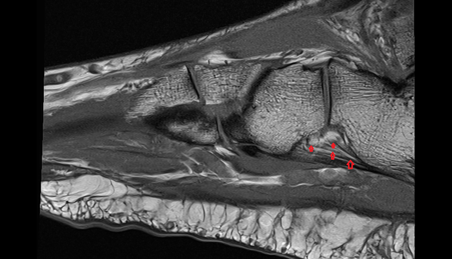 Plantar calcaneocuboid ligament (short plantar ligament)  SAGITTAL cross sectional anatomy 3T MRI AI enhanced radiology image-img-00000-00000