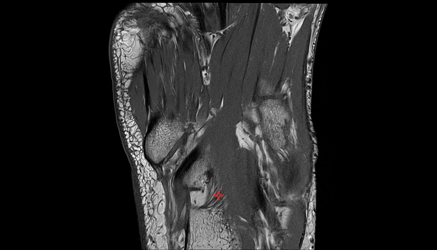 Plantar calcaneocuboid ligament (short plantar ligament)  coronal cross sectional anatomy 3T MRI AI enhanced radiology image-img-00000-00000