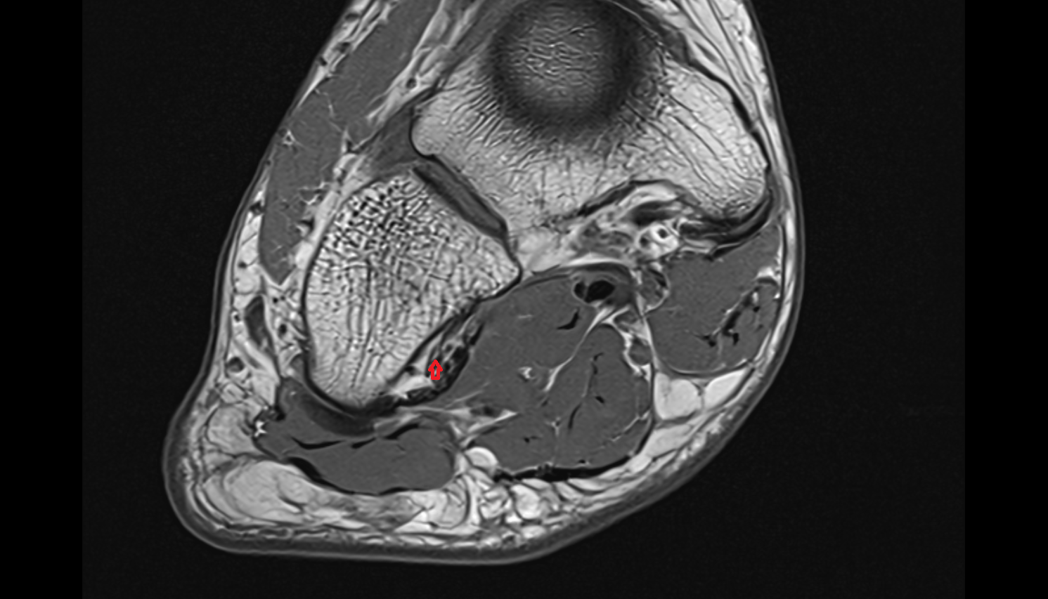 Plantar calcaneocuboid ligament (short plantar ligament)  coronal cross sectional anatomy 3T MRI AI enhanced radiology image-img-00000-00000_00001