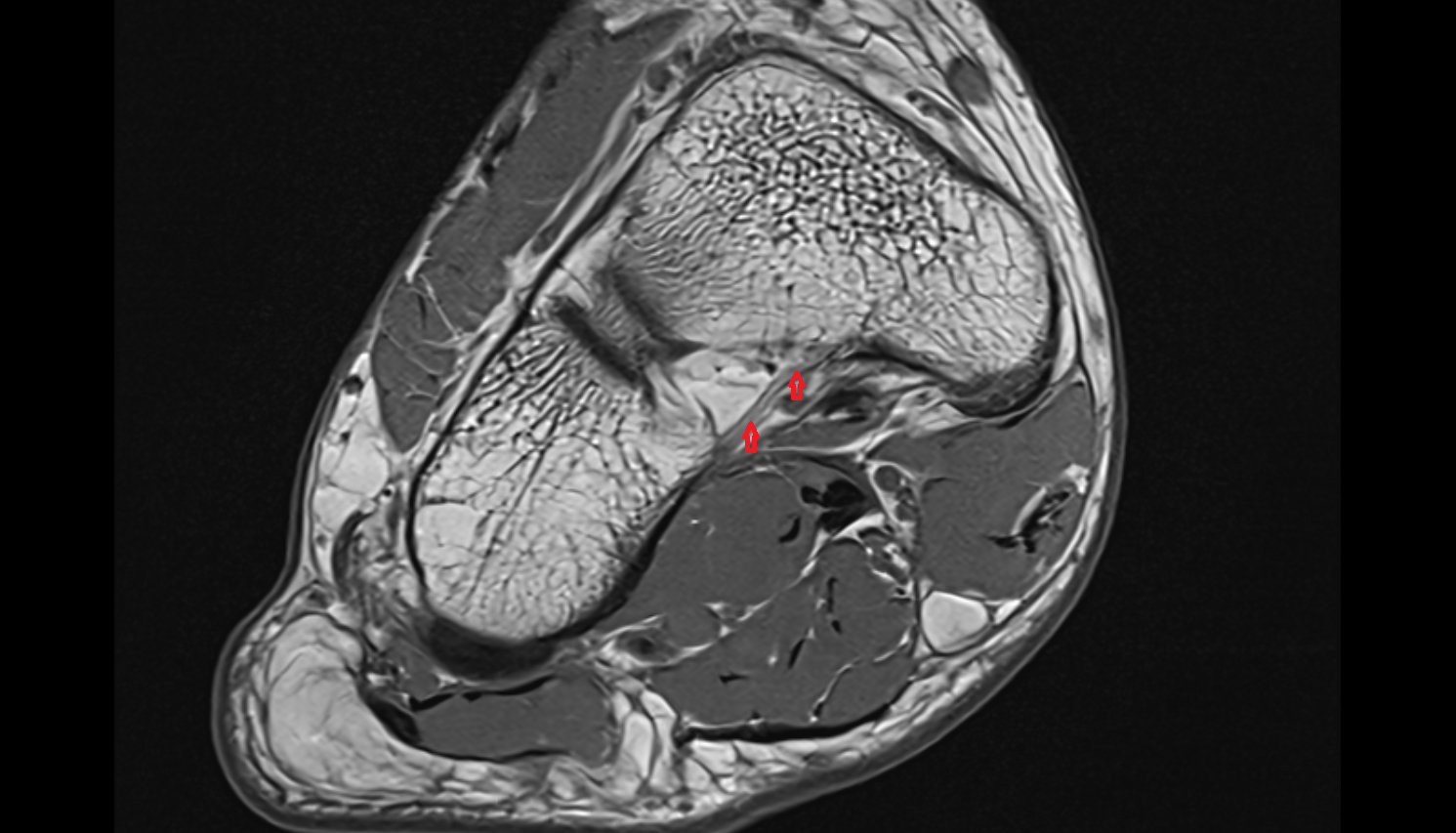 Plantar cuboideonavicular ligament  axial  cross sectional anatomy 3T MRI AI enhanced radiology image-img-00000-00000