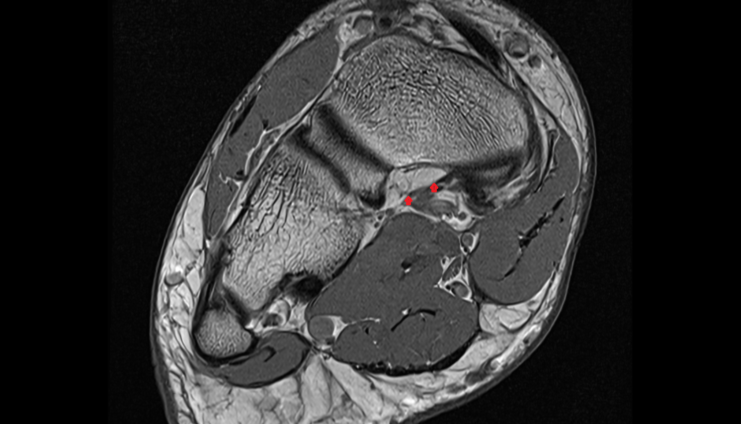 Plantar cuneonavicular ligaments axial cross sectional anatomy 3T MRI AI enhanced radiology image-img-00000-00000