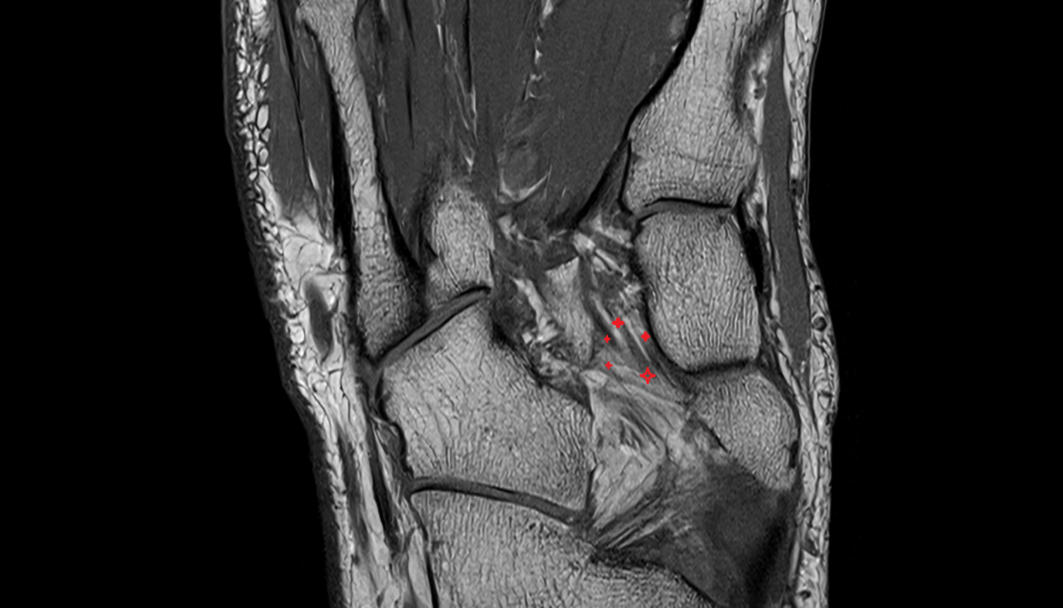 Plantar cuneonavicular ligaments coronal cross sectional anatomy 3T MRI AI enhanced radiology image-img-00000-00000