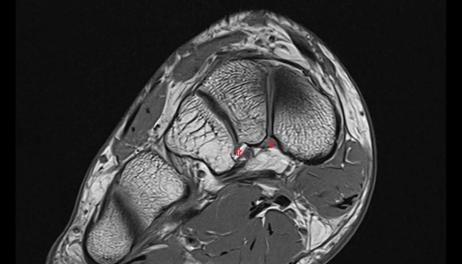 Plantar intercuneiform ligaments axial cross sectional anatomy 3T MRI AI enhanced radiology image-img-00000-00000
