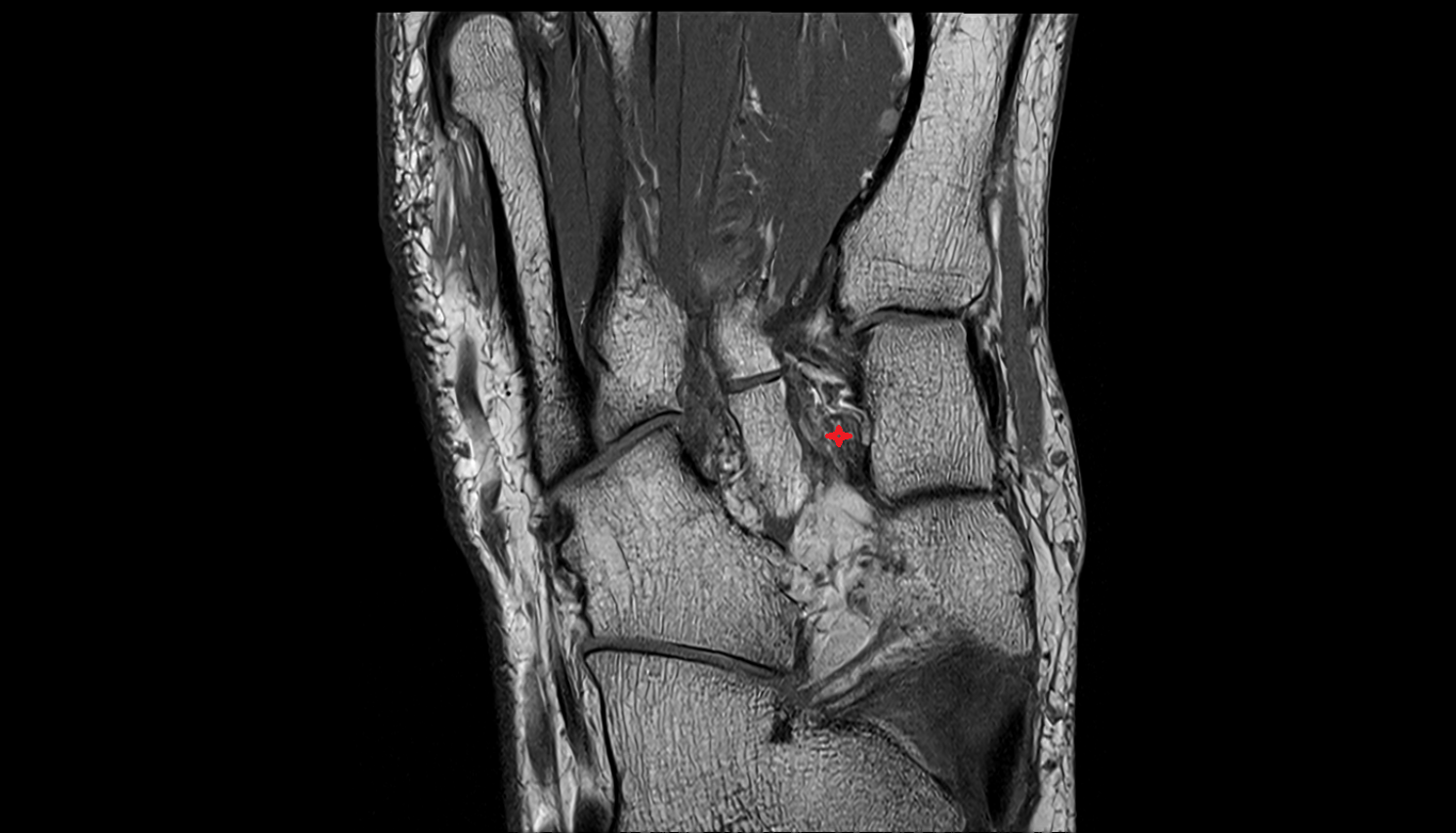 Plantar intercuneiform ligaments axial cross sectional anatomy 3T MRI AI enhanced radiology image-img-00000-00000_00002