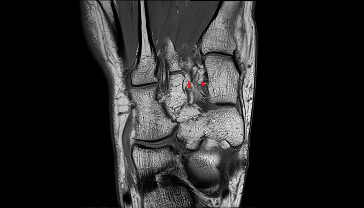 Plantar intercuneiform ligaments coronal cross sectional anatomy 3T MRI AI enhanced radiology image-img-00000-00000