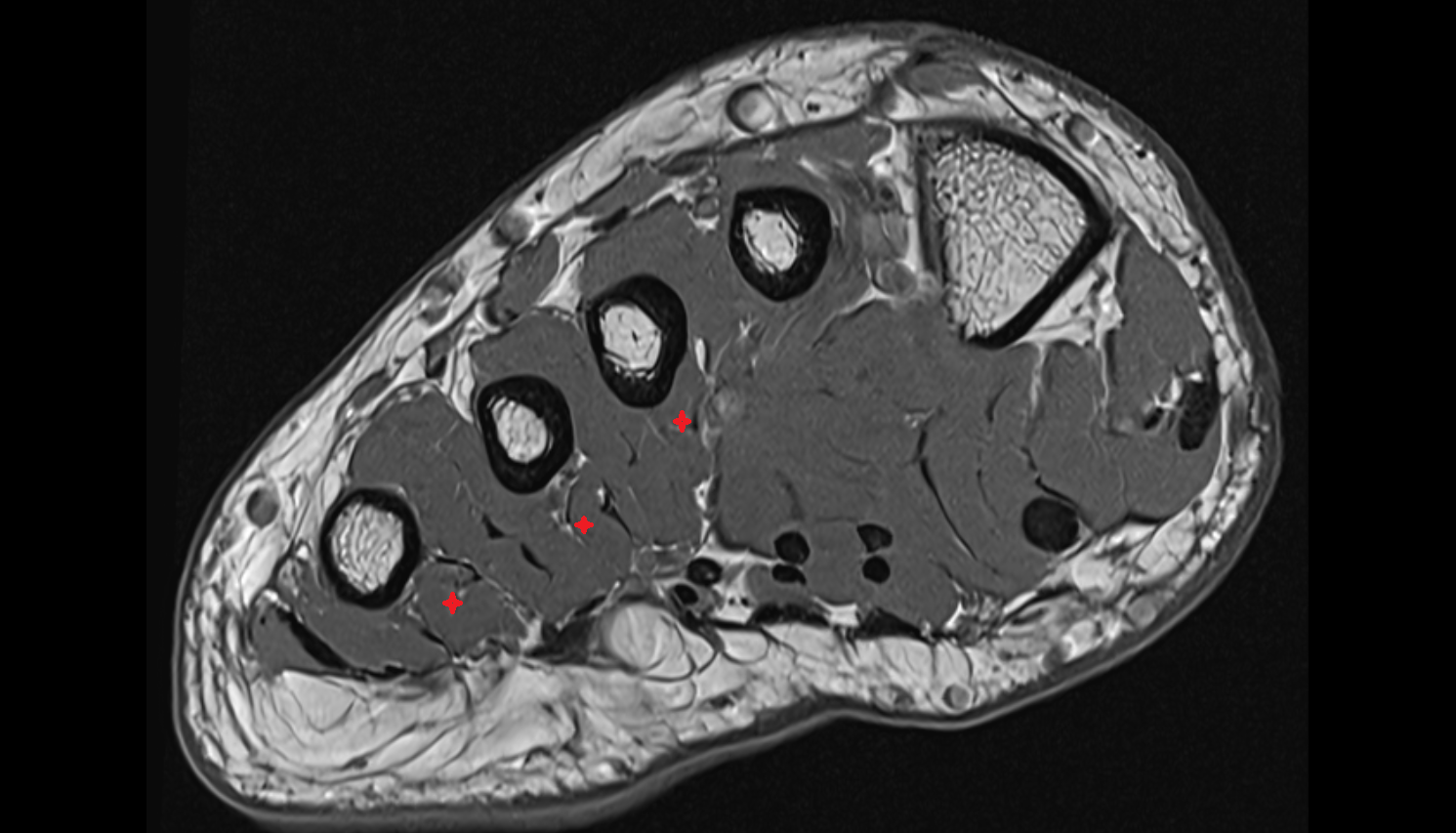 Plantar interosseous muscles axial cross sectional anatomy 3T MRI AI enhanced radiology image-img-00000-00000