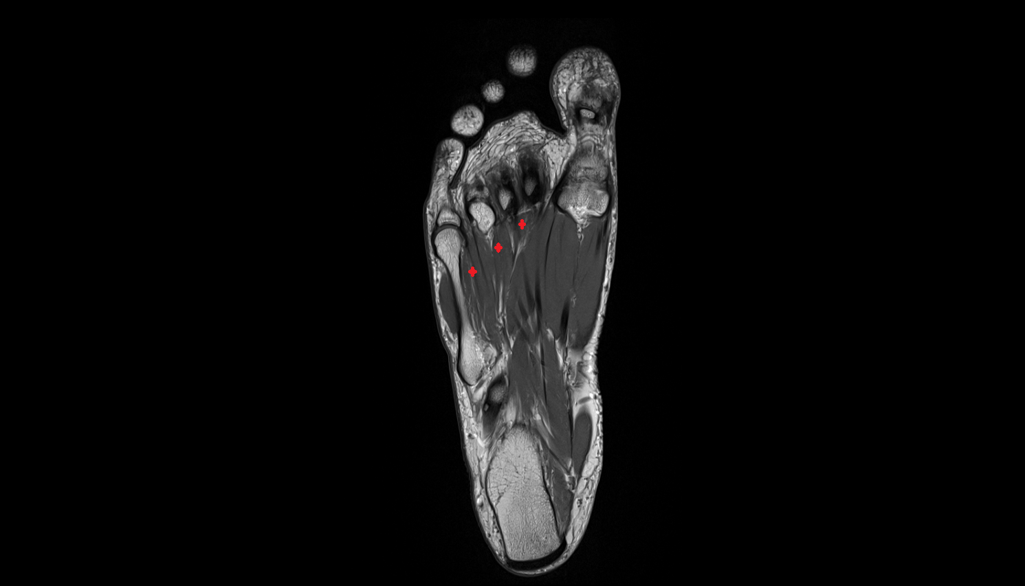 Plantar interosseous muscles coronal cross sectional anatomy 3T MRI AI enhanced radiology image-img-00000-00000