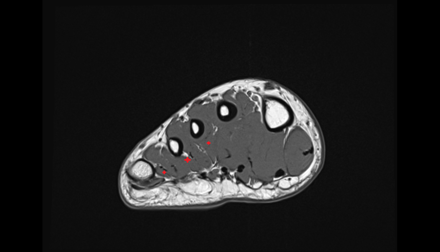 Plantar interosseous muscles coronal cross sectional anatomy 3T MRI AI enhanced radiology image-img-00000-00000_00001