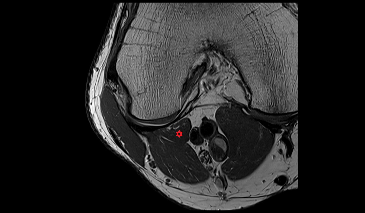Plantaris muscle axial image