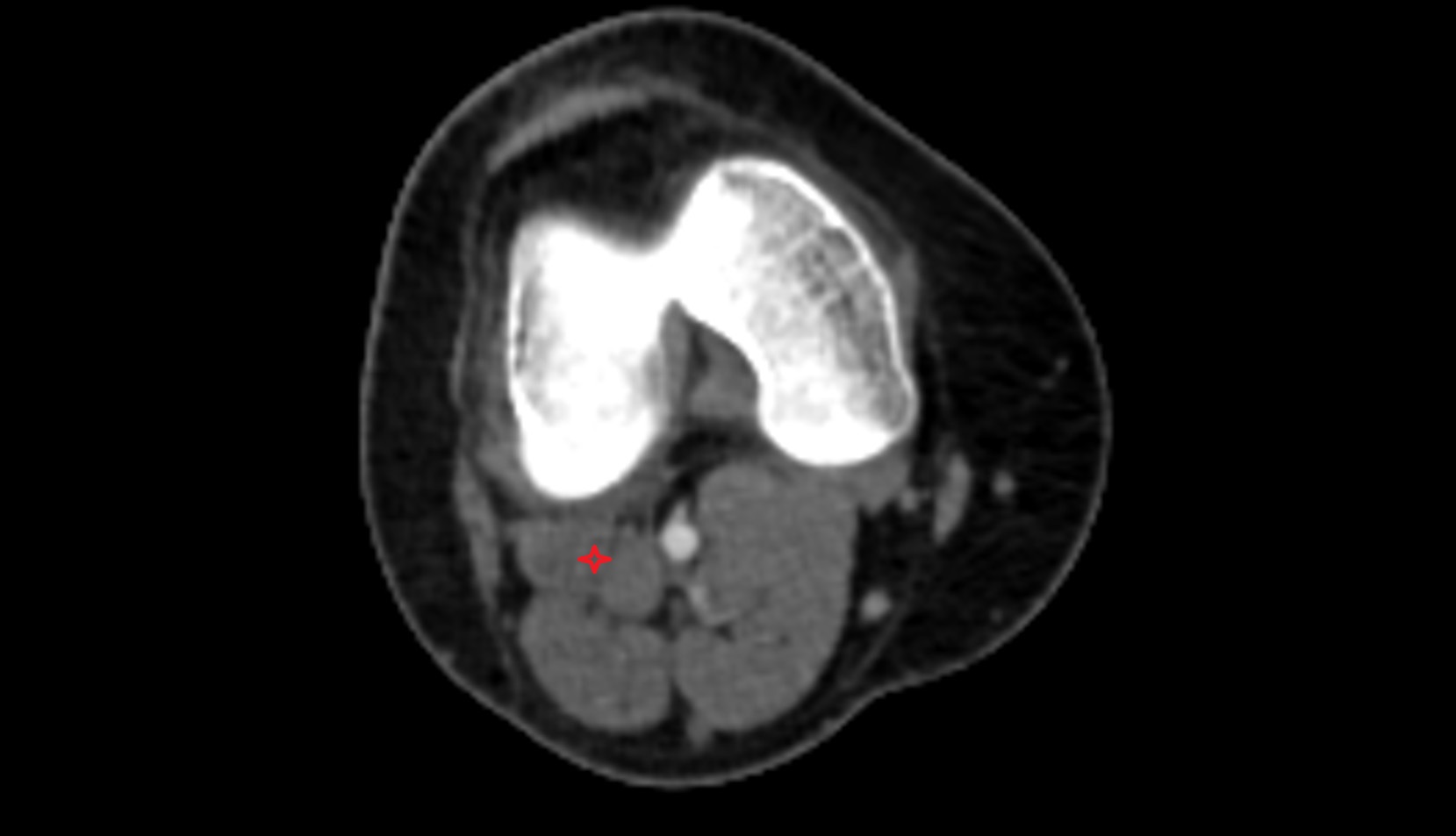Plantaris muscle ct axial image