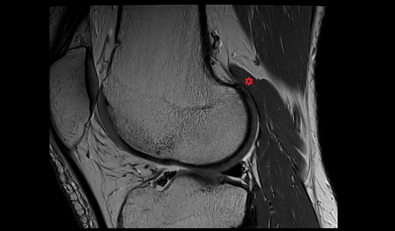 Plantaris muscle mri image