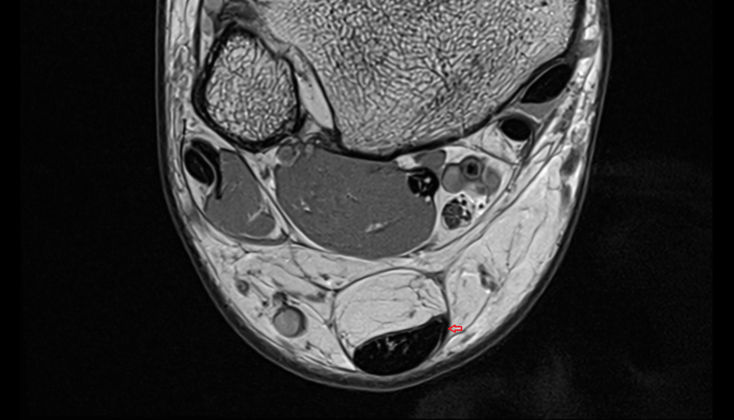 Plantaris tendon axial cross sectional anatomy 3T MRI AI enhanced radiology image-img-00000-00000
