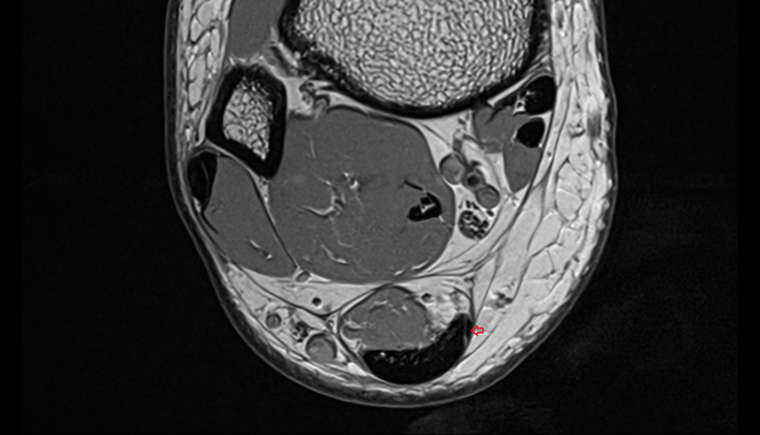 Plantaris tendon axial cross sectional anatomy 3T MRI AI enhanced radiology image-img-00000-00000_00001