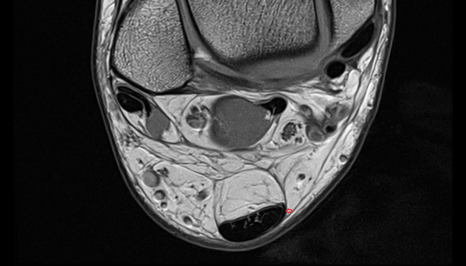 Plantaris tendon axial cross sectional anatomy 3T MRI AI enhanced radiology image-img-00000-00000_00002