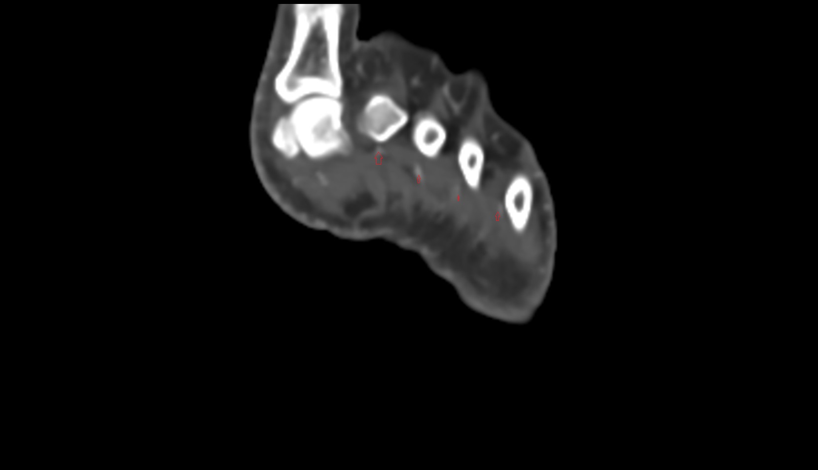 Plantar metatarsal arteries ct axial
