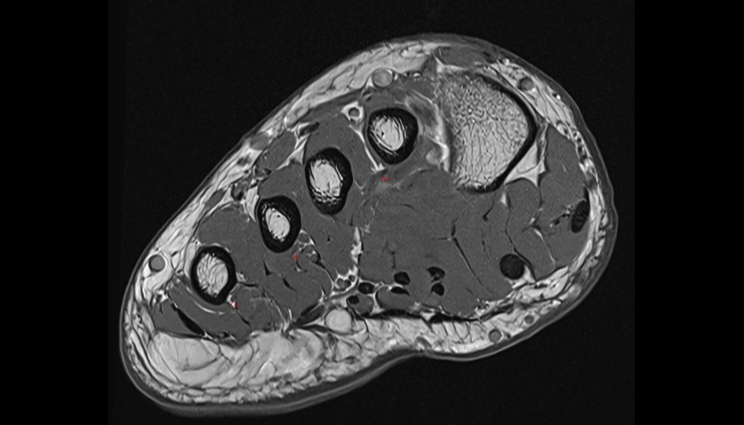 Plantar metatarsal arteries of foot  sfov  of the Foot axial cross sectional anatomy 3T MRI AI enhanced radiology image-img-00000-00000