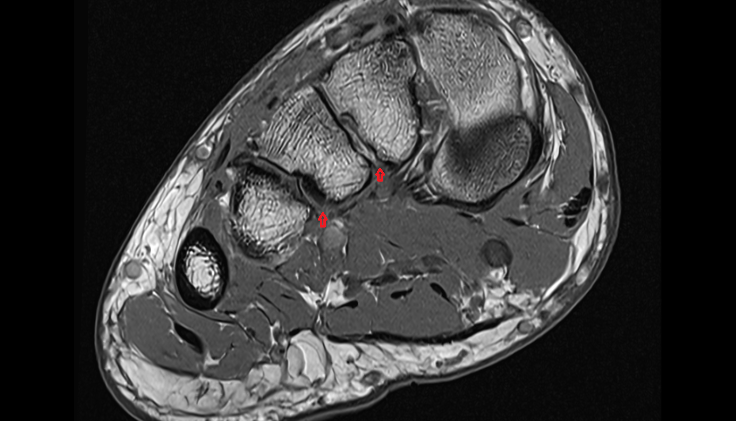 Plantar metatarsal ligaments  coronal cross sectional anatomy 3T MRI AI enhanced radiology image-img-00000-00000