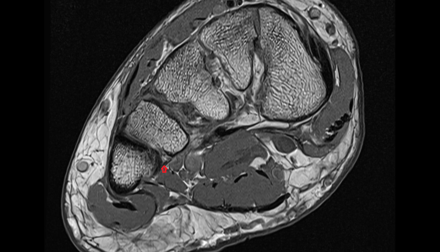 Plantar metatarsal ligaments  coronal cross sectional anatomy 3T MRI AI enhanced radiology image-img-00000-00000_00001
