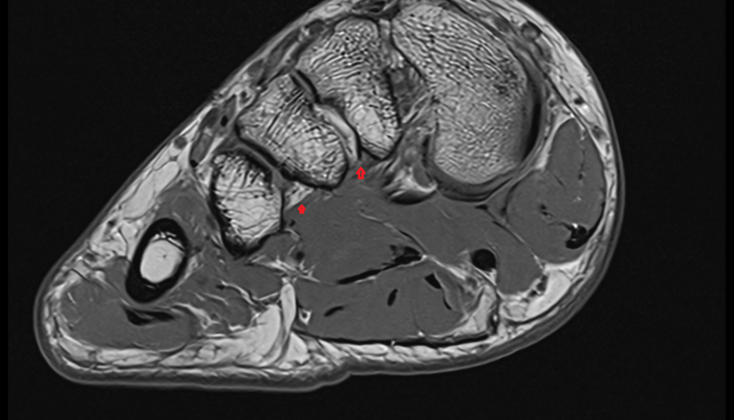 Plantar metatarsal ligaments  coronal cross sectional anatomy 3T MRI AI enhanced radiology image-img-00000-00000_00002