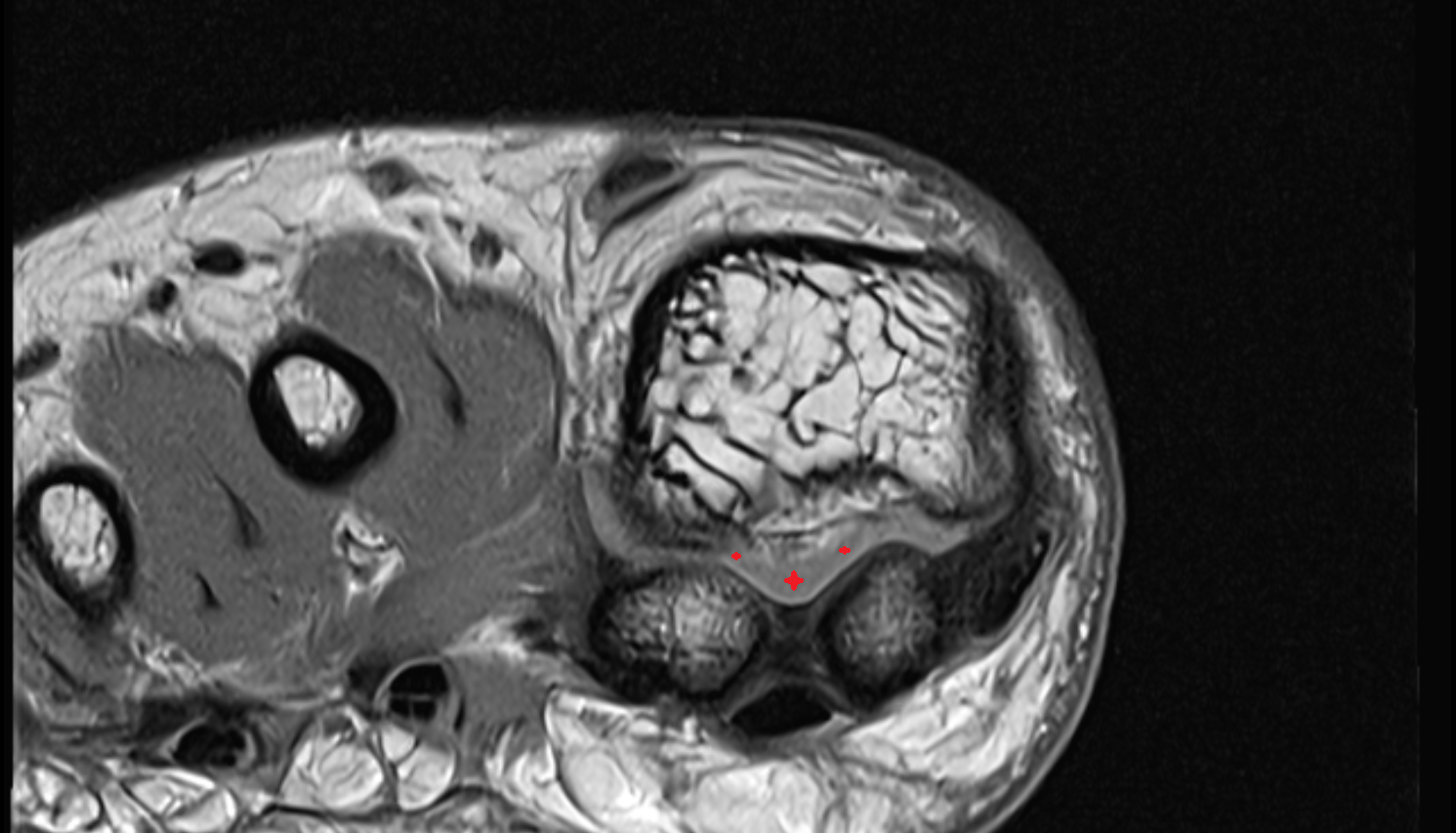 Plantar plate ligament of foot  AXIAL cross sectional anatomy 3T MRI AI enhanced radiology image-img-00000-00000