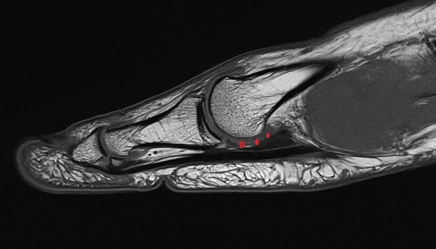 Plantar plate ligament of foot  sag cross sectional anatomy 3T MRI AI enhanced radiology image-img-00000-00000_00001