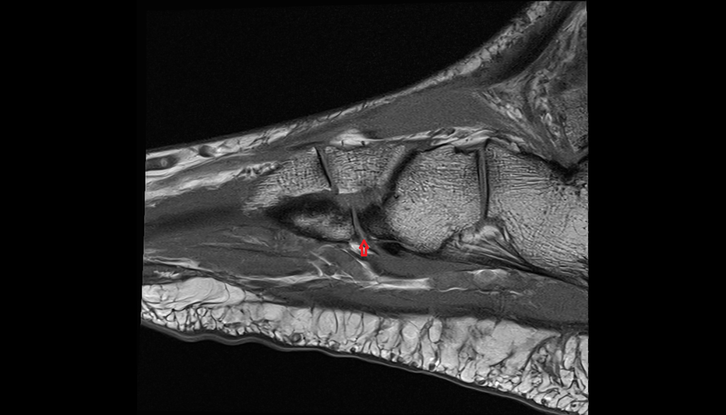 Plantar tarsometatarsal ligaments  SAGITTAL cross sectional anatomy 3T MRI AI enhanced radiology image-img-00000-00000