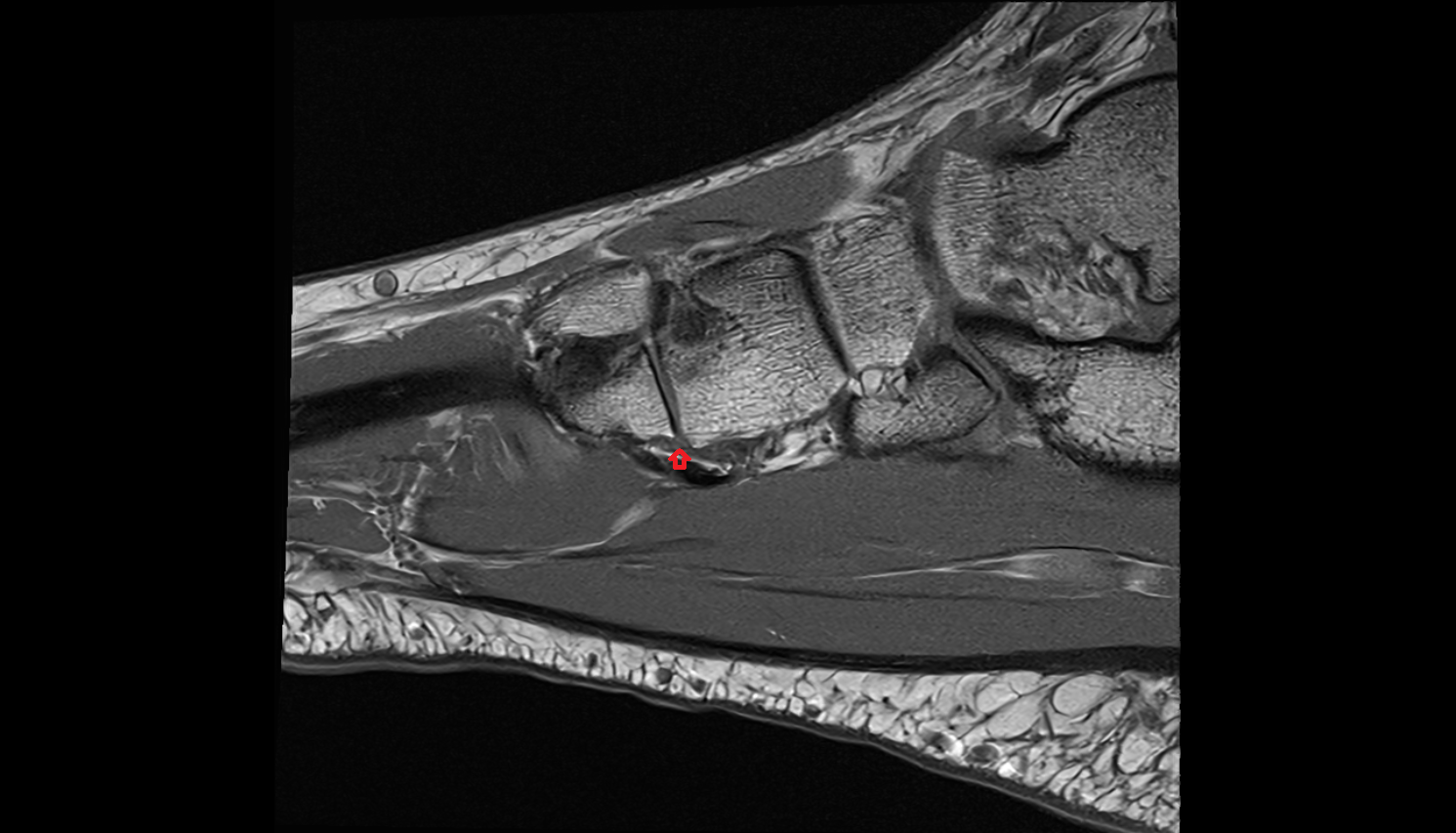 Plantar tarsometatarsal ligaments  SAGITTAL cross sectional anatomy 3T MRI AI enhanced radiology image-img-00000-00000_00001