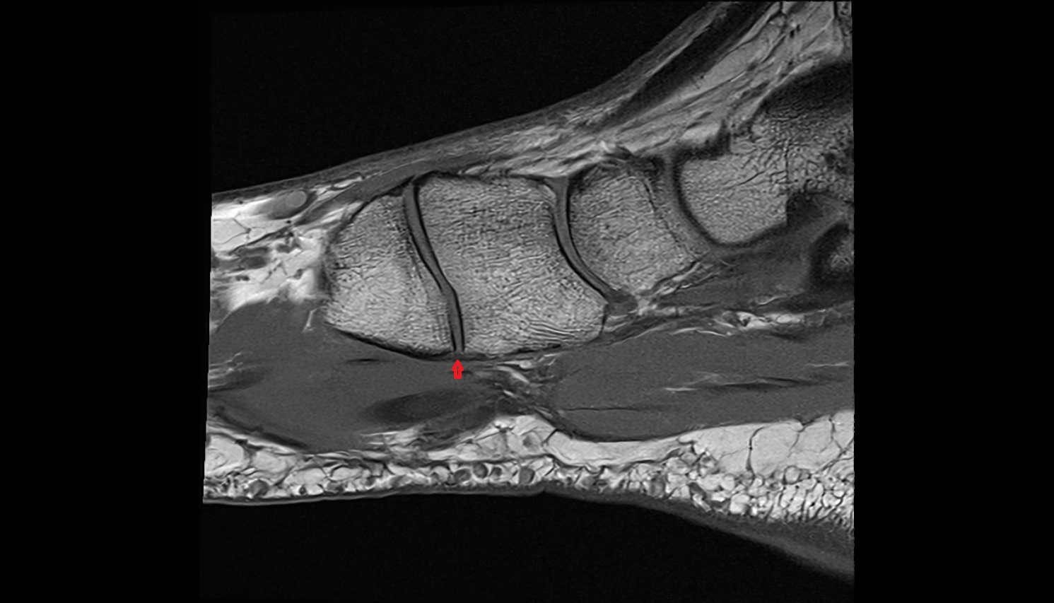 Plantar tarsometatarsal ligaments  SAGITTAL cross sectional anatomy 3T MRI AI enhanced radiology image-img-00000-00000_00002