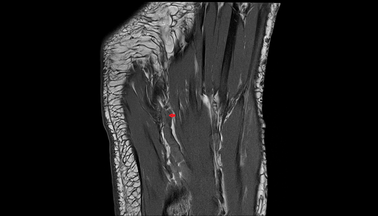 Plantar venous arch of foot coronal cross sectional anatomy 3T MRI AI enhanced radiology image-img-00000-00000