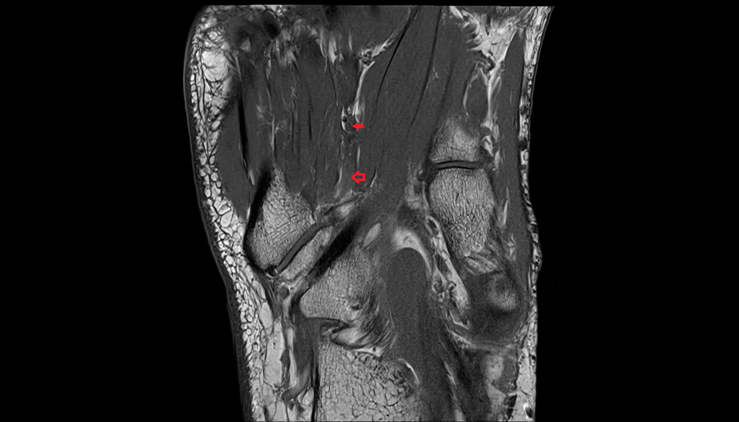 Plantar venous arch of foot coronal cross sectional anatomy 3T MRI AI enhanced radiology image-img-00000-00000_00001