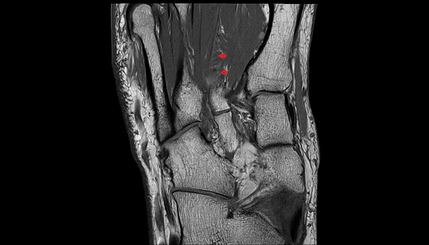 Plantar venous arch of foot coronal cross sectional anatomy 3T MRI AI enhanced radiology image-img-00000-00000_00002