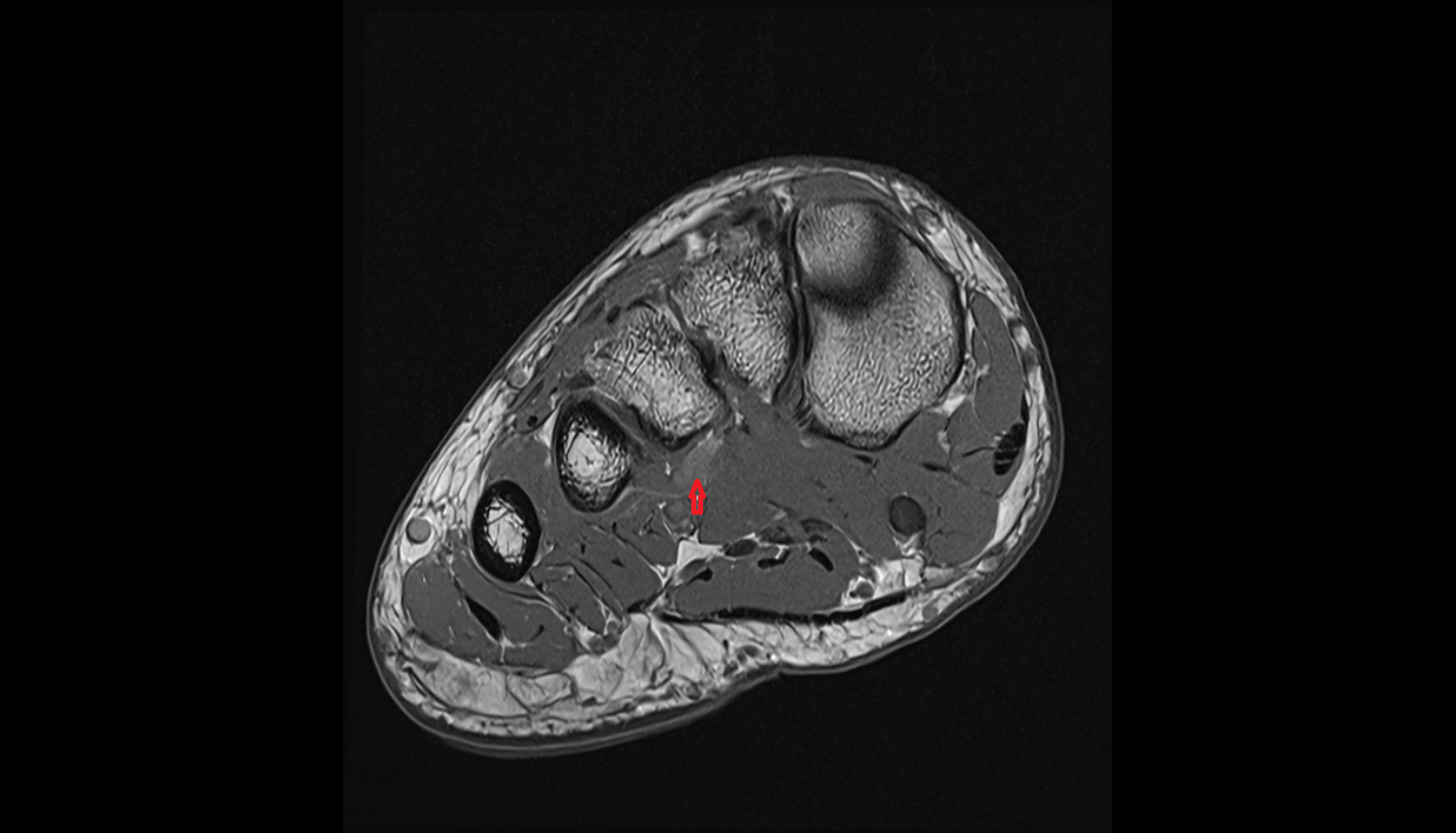Plantar venous arch of foot coronal cross sectional anatomy 3T MRI AI enhanced radiology image-img-00000-00000_00003