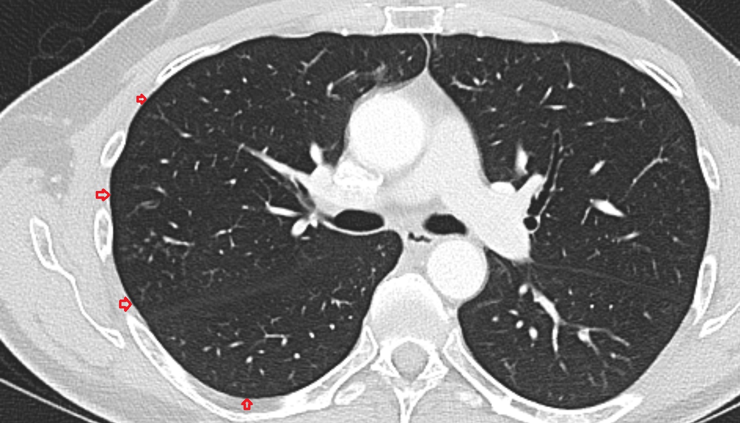 Pleura  anatomy CT AXIAL  image -img-00000-00000