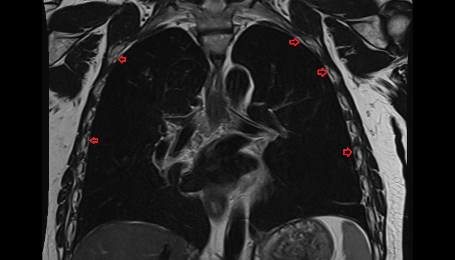 Pleura  anatomy MRI coronalL  image -img-00000-00000