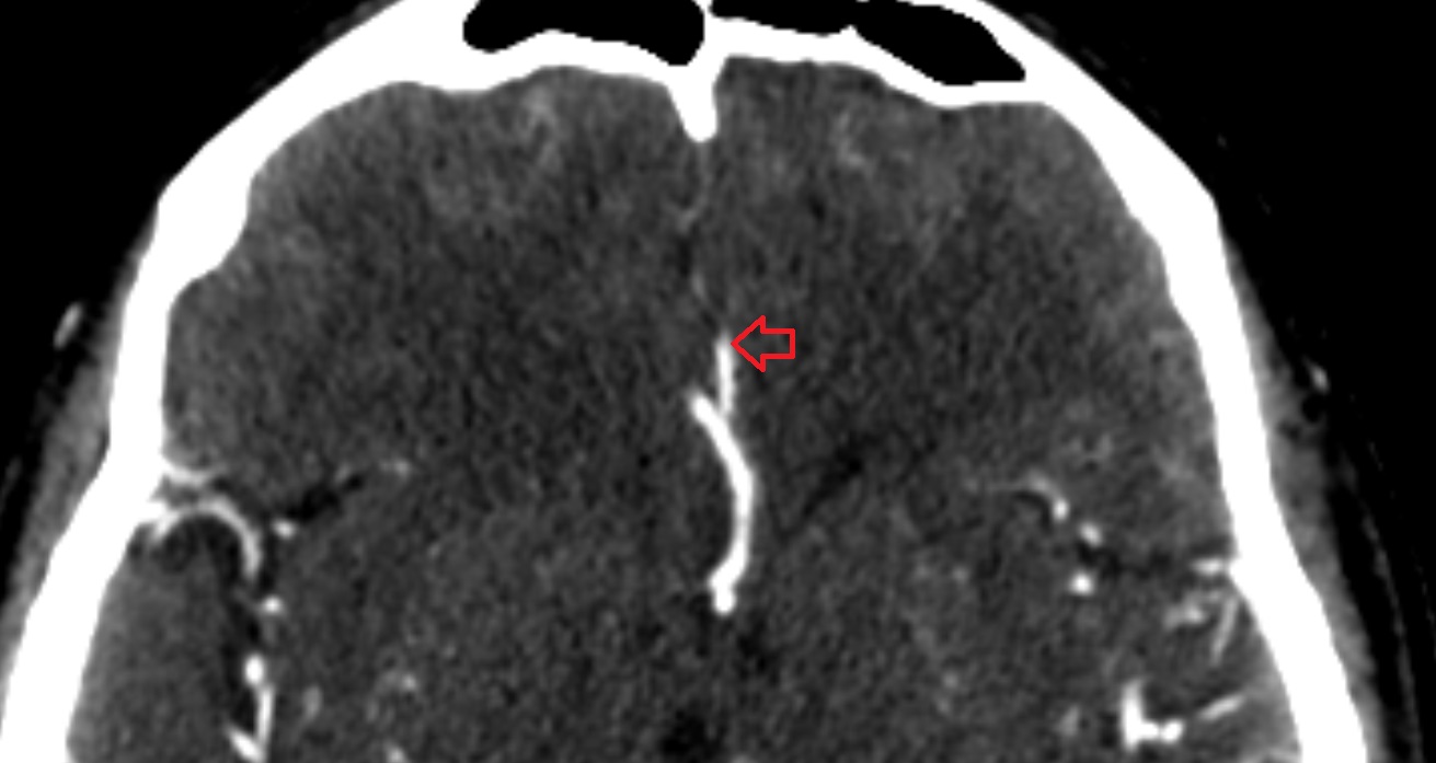 Polar frontal artery ct image